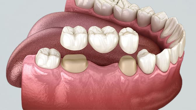 Prothèses dentaires et couronnes - Centre Dentaire AMIRAL Agadir